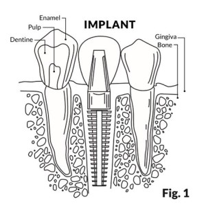 Implant Wall Sticker